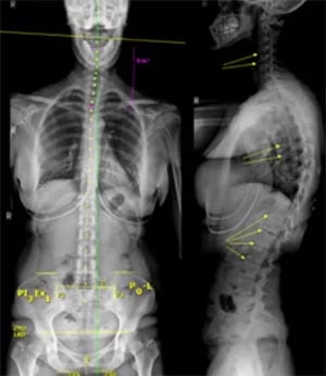 Chiropractic Lincoln NE First Visit X Ray